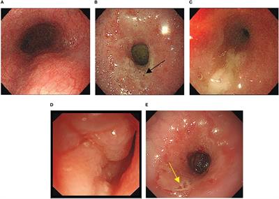 Case report: A rare case of sintilimab-induced gastric stenosis and literature review